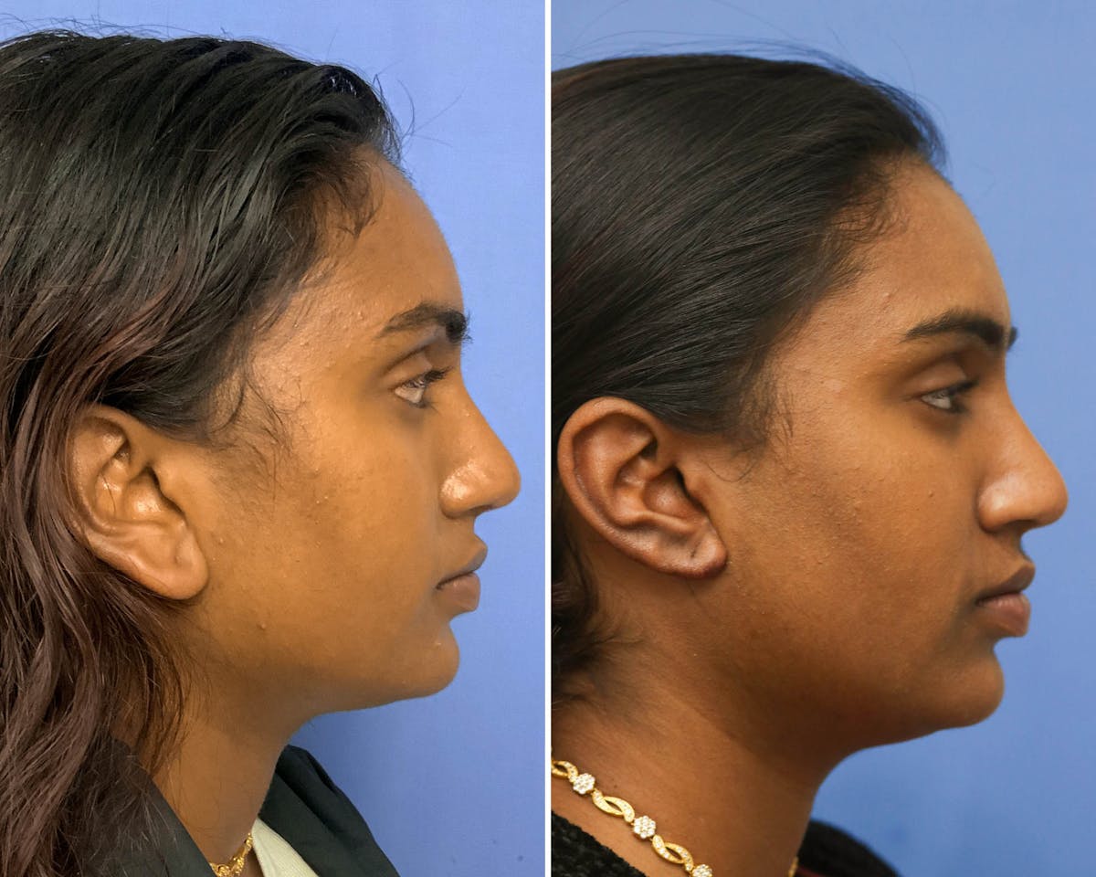Otoplasty Before & After Gallery - Patient 183224 - Image 3