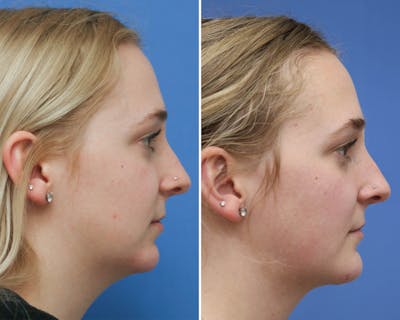 Rhinoplasty Before & After Gallery - Patient 496968 - Image 1