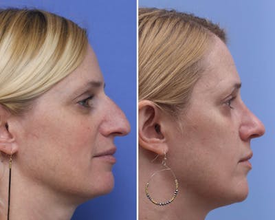 Rhinoplasty Before & After Gallery - Patient 418040 - Image 1