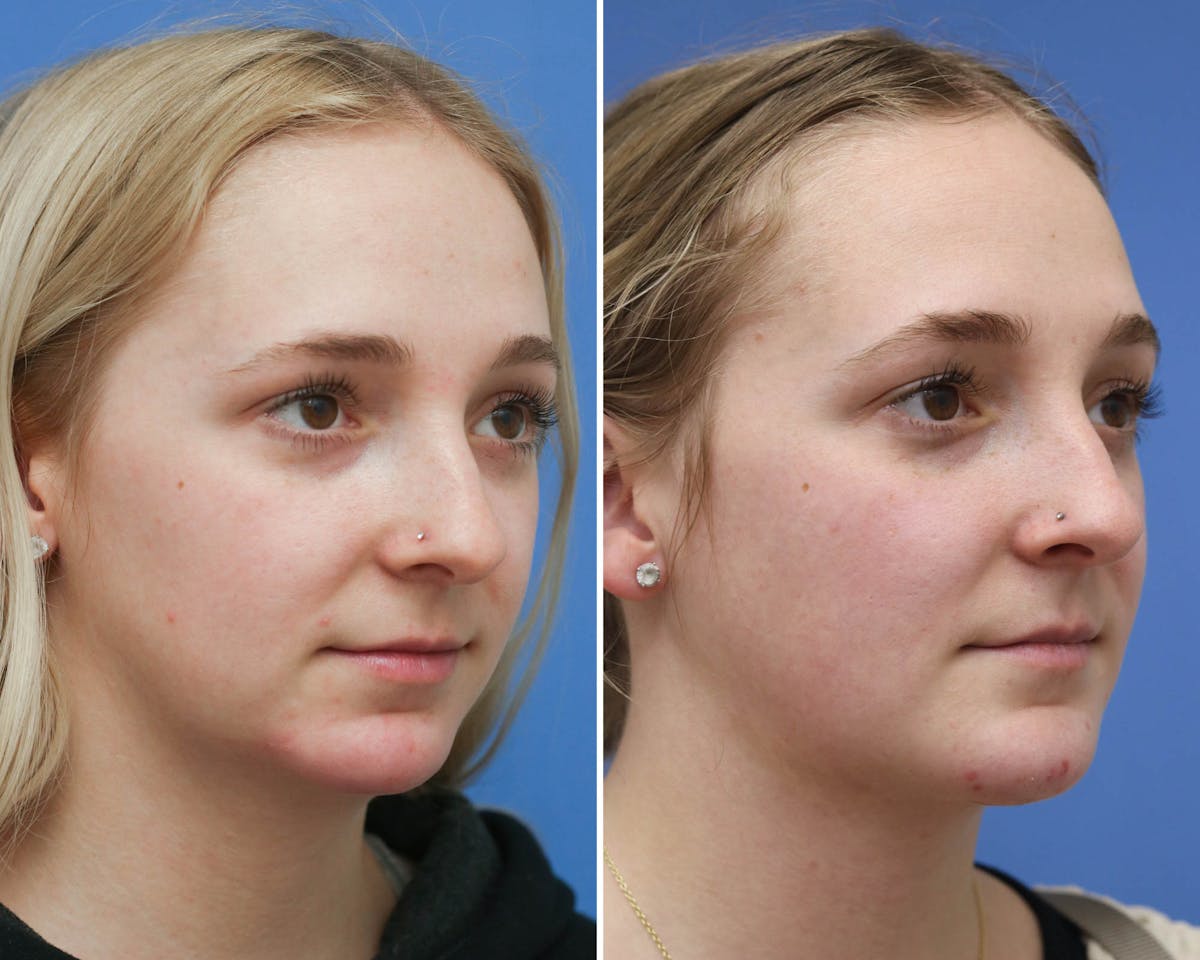 Rhinoplasty Before & After Gallery - Patient 496968 - Image 2