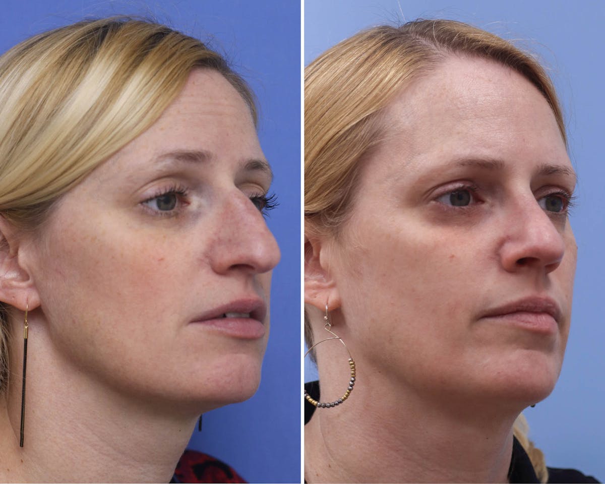 Rhinoplasty Before & After Gallery - Patient 418040 - Image 2