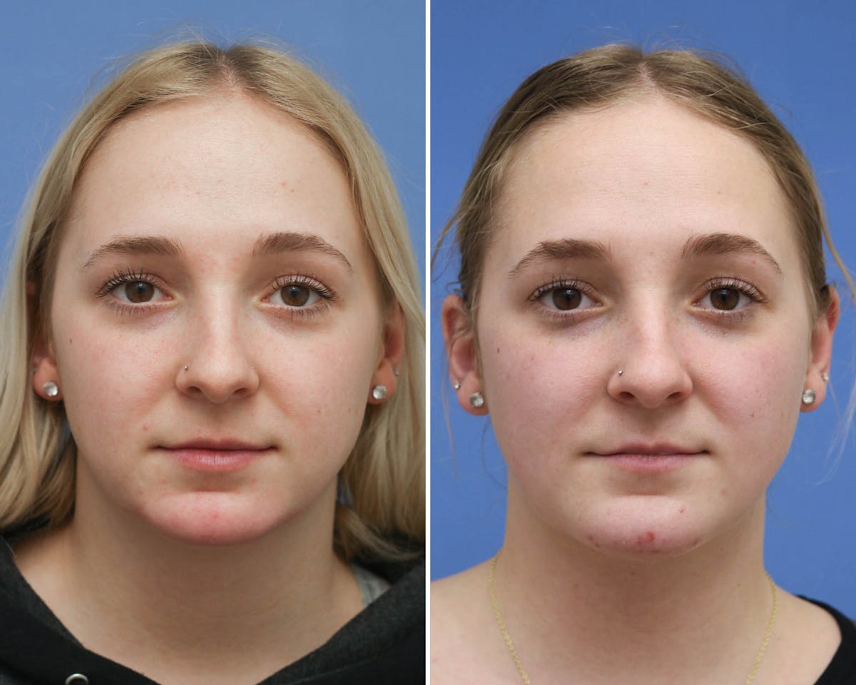 Rhinoplasty Before & After Gallery - Patient 496968 - Image 3
