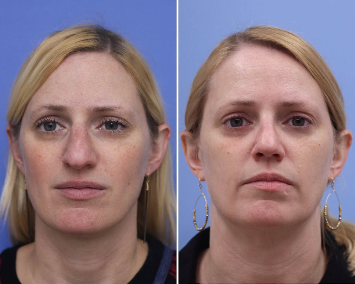 Rhinoplasty Before & After Gallery - Patient 418040 - Image 3