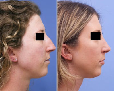 Rhinoplasty Before & After Gallery - Patient 757145 - Image 1
