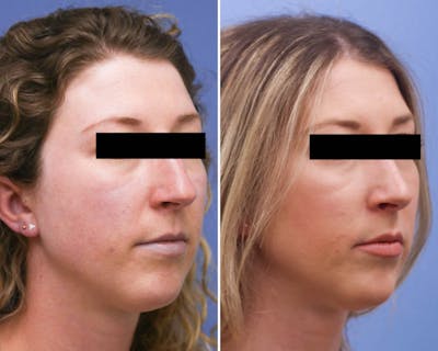 Rhinoplasty Before & After Gallery - Patient 352944 - Image 1