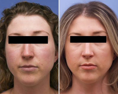 Rhinoplasty Before & After Gallery - Patient 748744 - Image 1