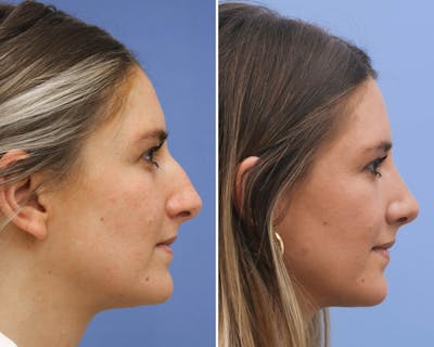 Rhinoplasty Before & After Gallery - Patient 150677 - Image 1
