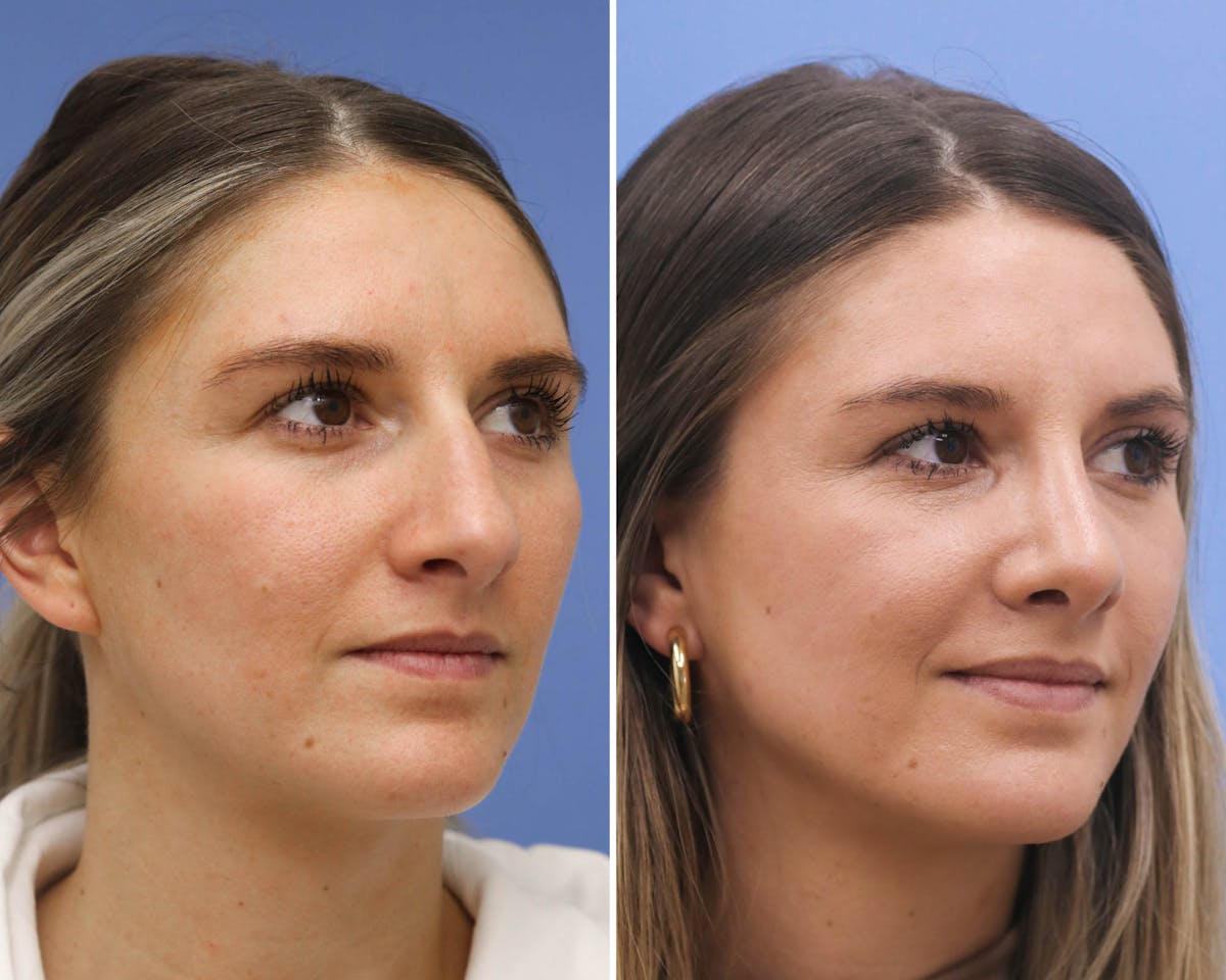 Rhinoplasty Before & After Gallery - Patient 243710 - Image 1