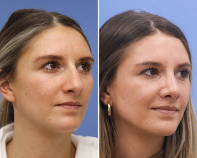 Rhinoplasty Before & After Gallery - Patient 243710 - Image 1
