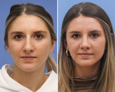 Rhinoplasty Before & After Gallery - Patient 422495 - Image 1