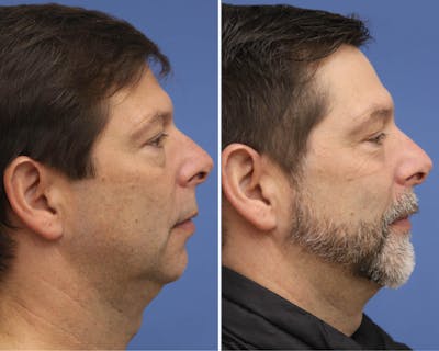 Chin Implants Before & After Gallery - Patient 261243 - Image 1