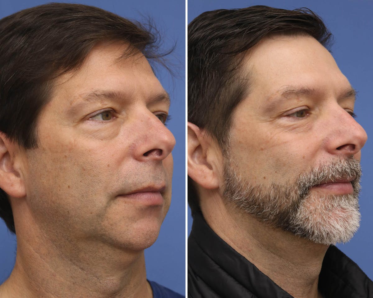 Chin Implants Before & After Gallery - Patient 261243 - Image 2