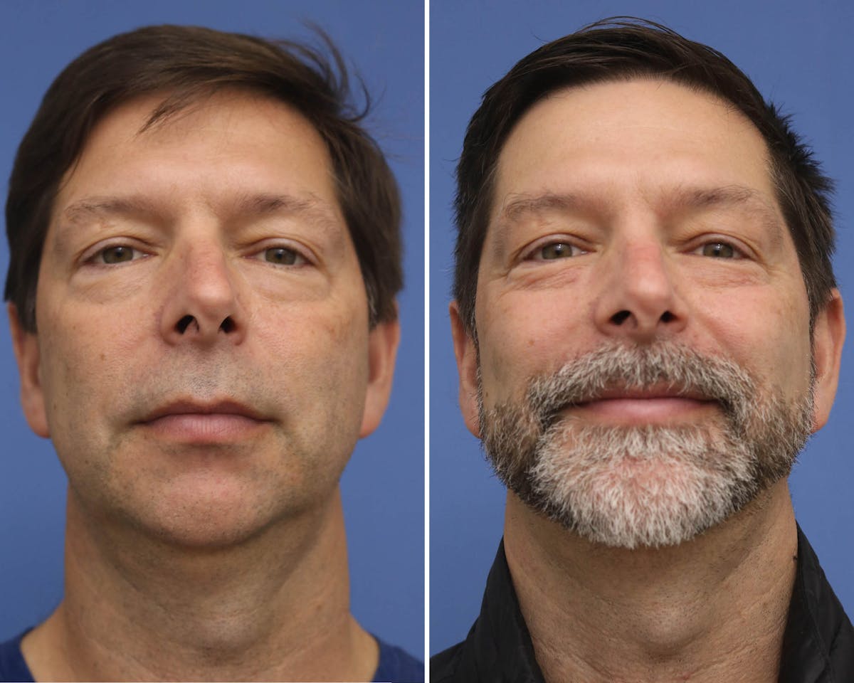 Chin Implants Before & After Gallery - Patient 261243 - Image 3