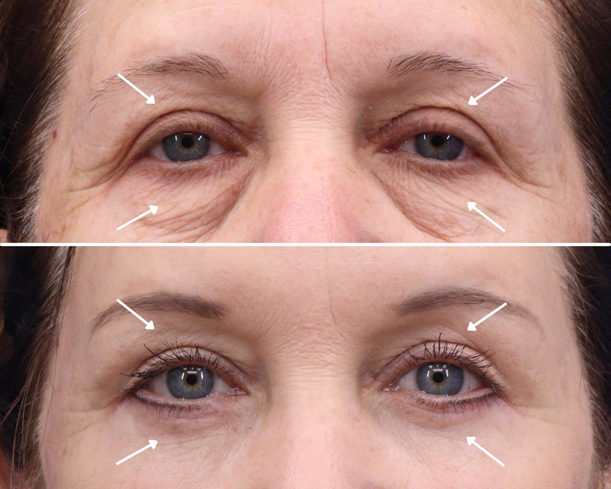 Blepharoplasty Before & After Gallery - Patient 376020 - Image 1
