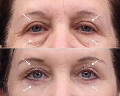 Blepharoplasty Before & After Gallery - Patient 376020 - Image 1