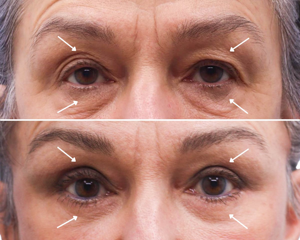 Blepharoplasty Before & After Gallery - Patient 227694 - Image 1