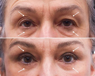 Blepharoplasty Before & After Gallery - Patient 227694 - Image 1