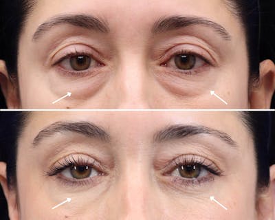 Blepharoplasty Before & After Gallery - Patient 183002 - Image 1
