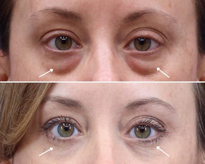 Blepharoplasty Before & After Gallery - Patient 337276 - Image 1