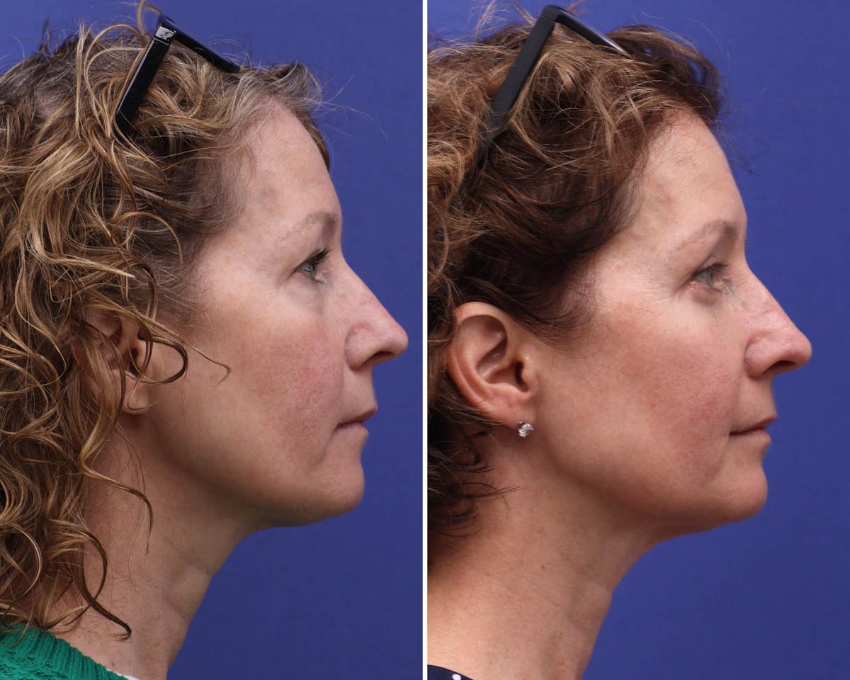Blepharoplasty Before & After Gallery - Patient 280658 - Image 2
