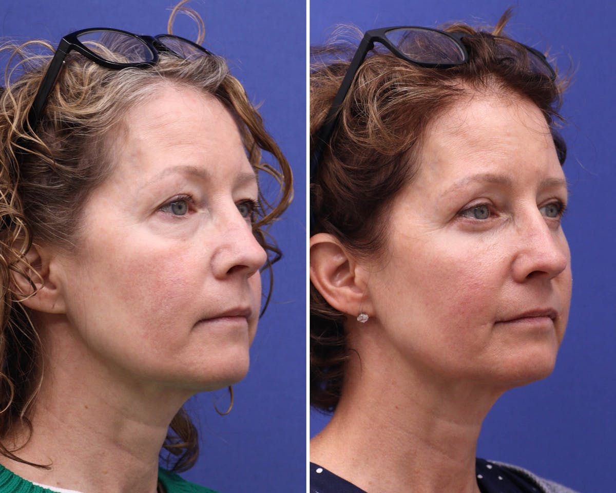 Blepharoplasty Before & After Gallery - Patient 280658 - Image 3