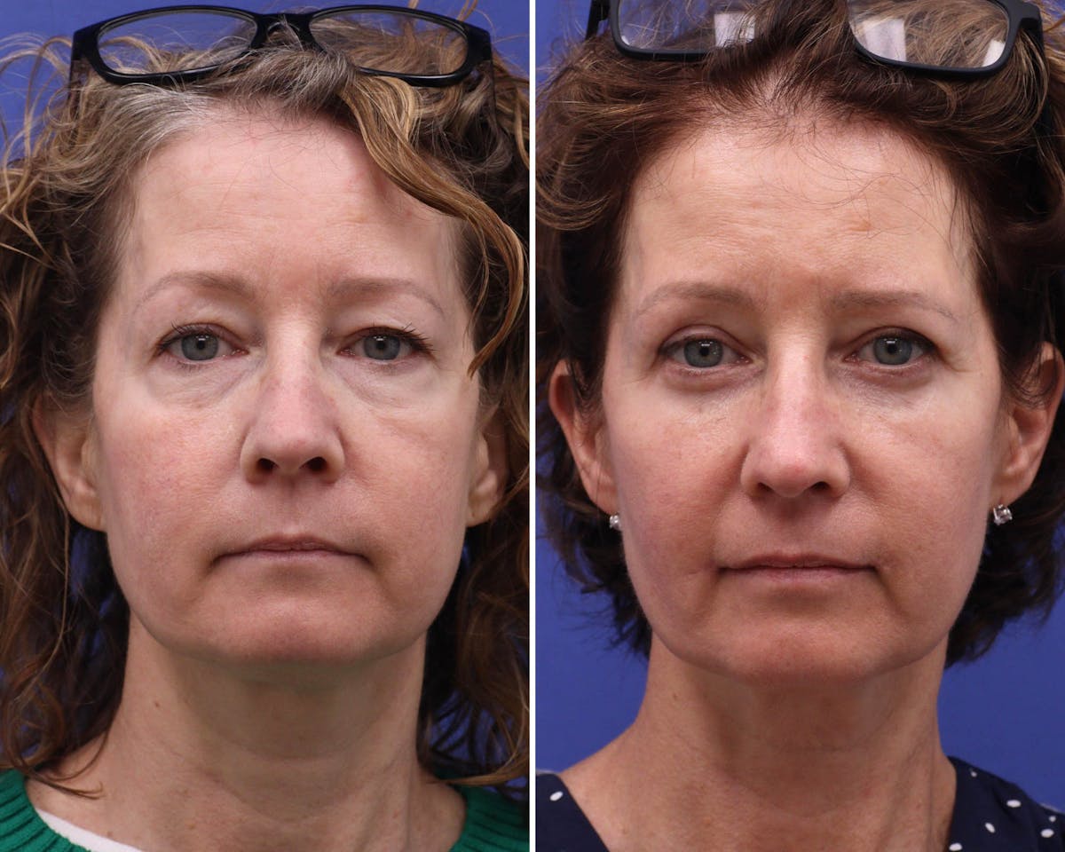 Blepharoplasty Before & After Gallery - Patient 280658 - Image 1