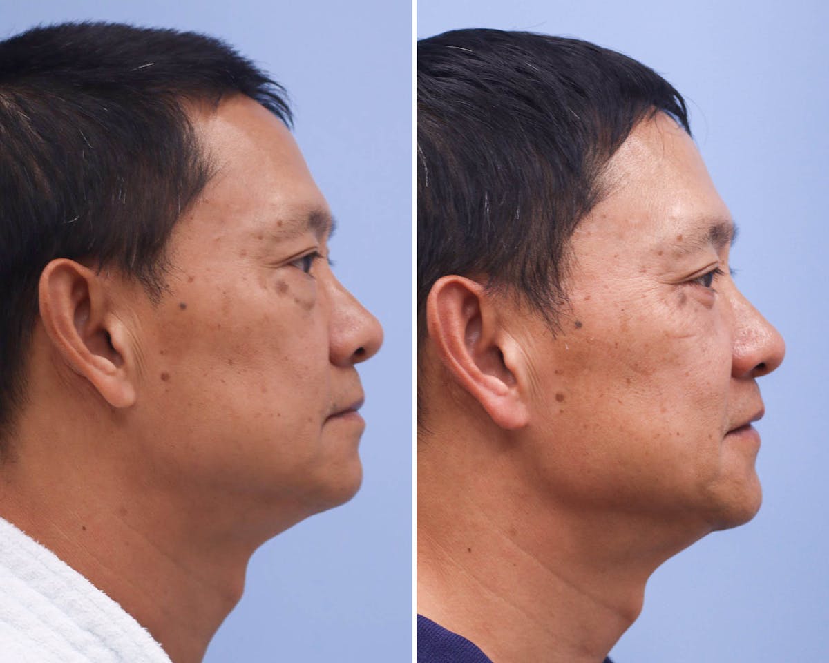 Blepharoplasty Before & After Gallery - Patient 163849 - Image 2