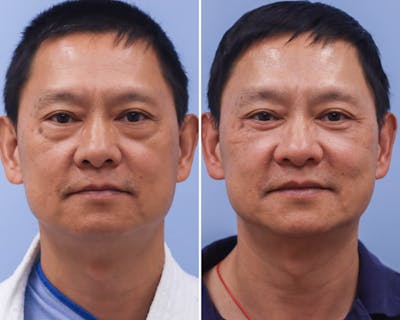 Blepharoplasty Before & After Gallery - Patient 163849 - Image 1