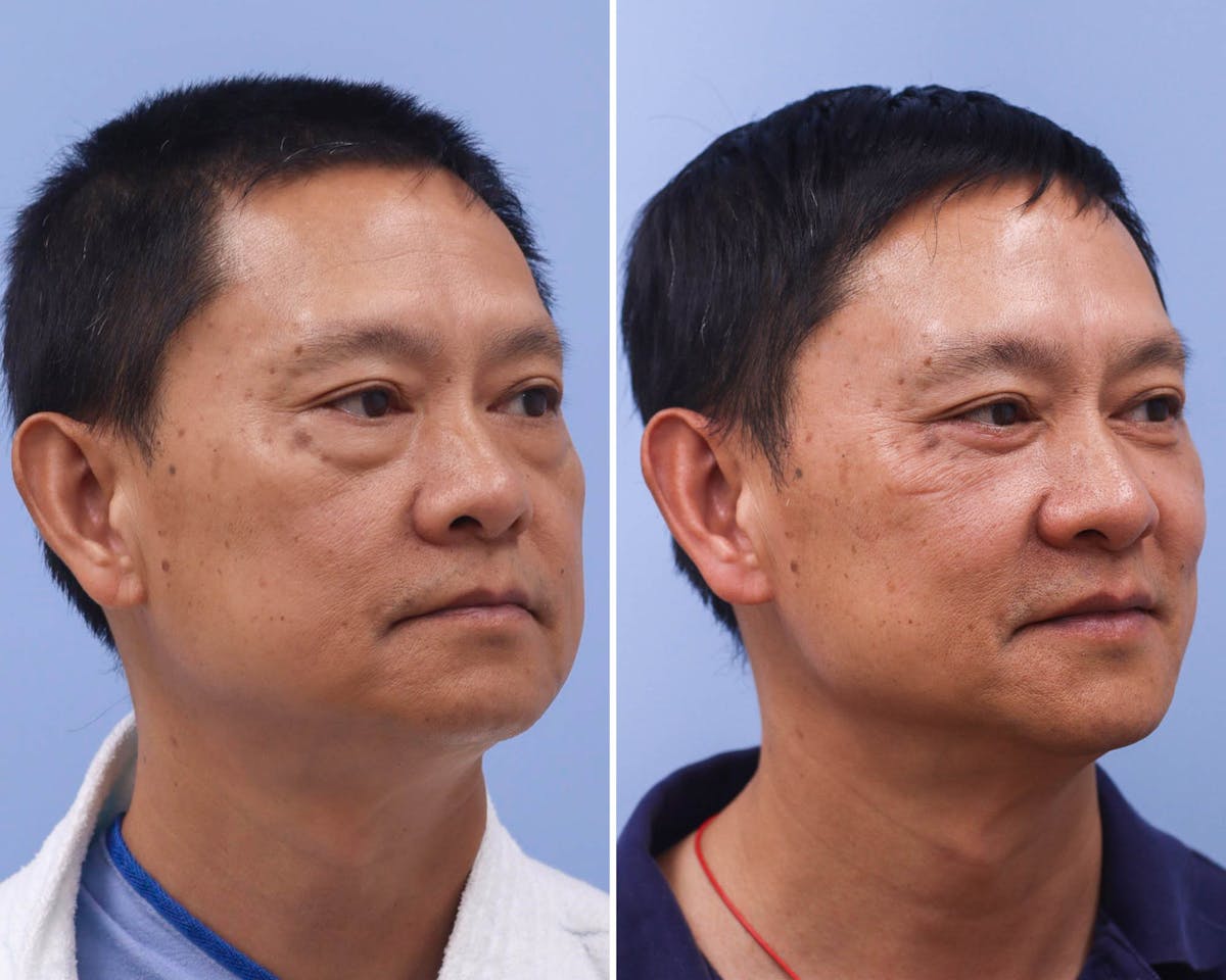 Blepharoplasty Before & After Gallery - Patient 163849 - Image 3