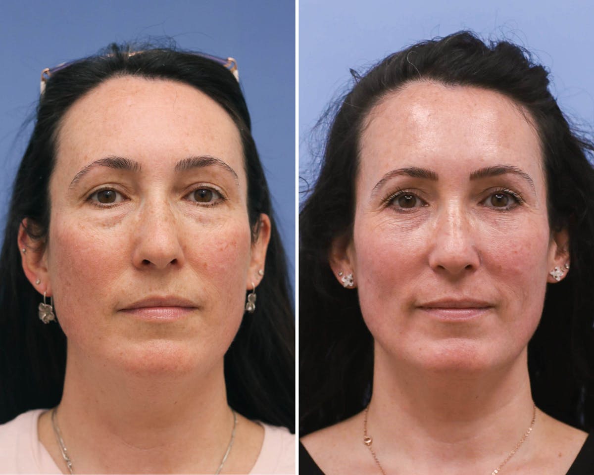 Blepharoplasty Before & After Gallery - Patient 823807 - Image 1