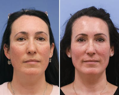 Blepharoplasty Before & After Gallery - Patient 823807 - Image 1