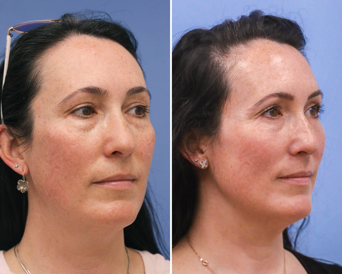 Blepharoplasty Before & After Gallery - Patient 823807 - Image 2