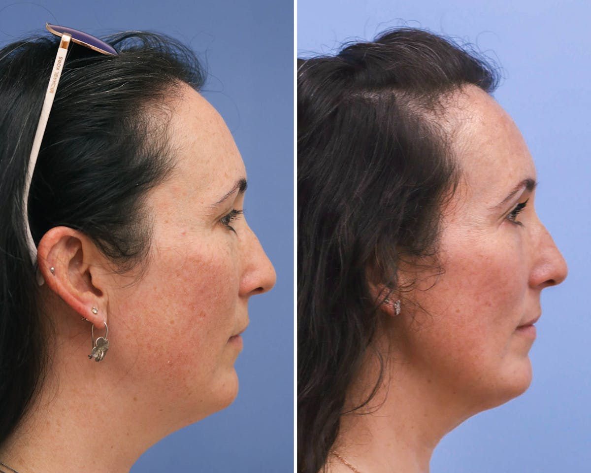 Blepharoplasty Before & After Gallery - Patient 823807 - Image 3