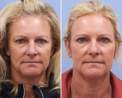 Blepharoplasty Before & After Gallery - Patient 847264 - Image 1