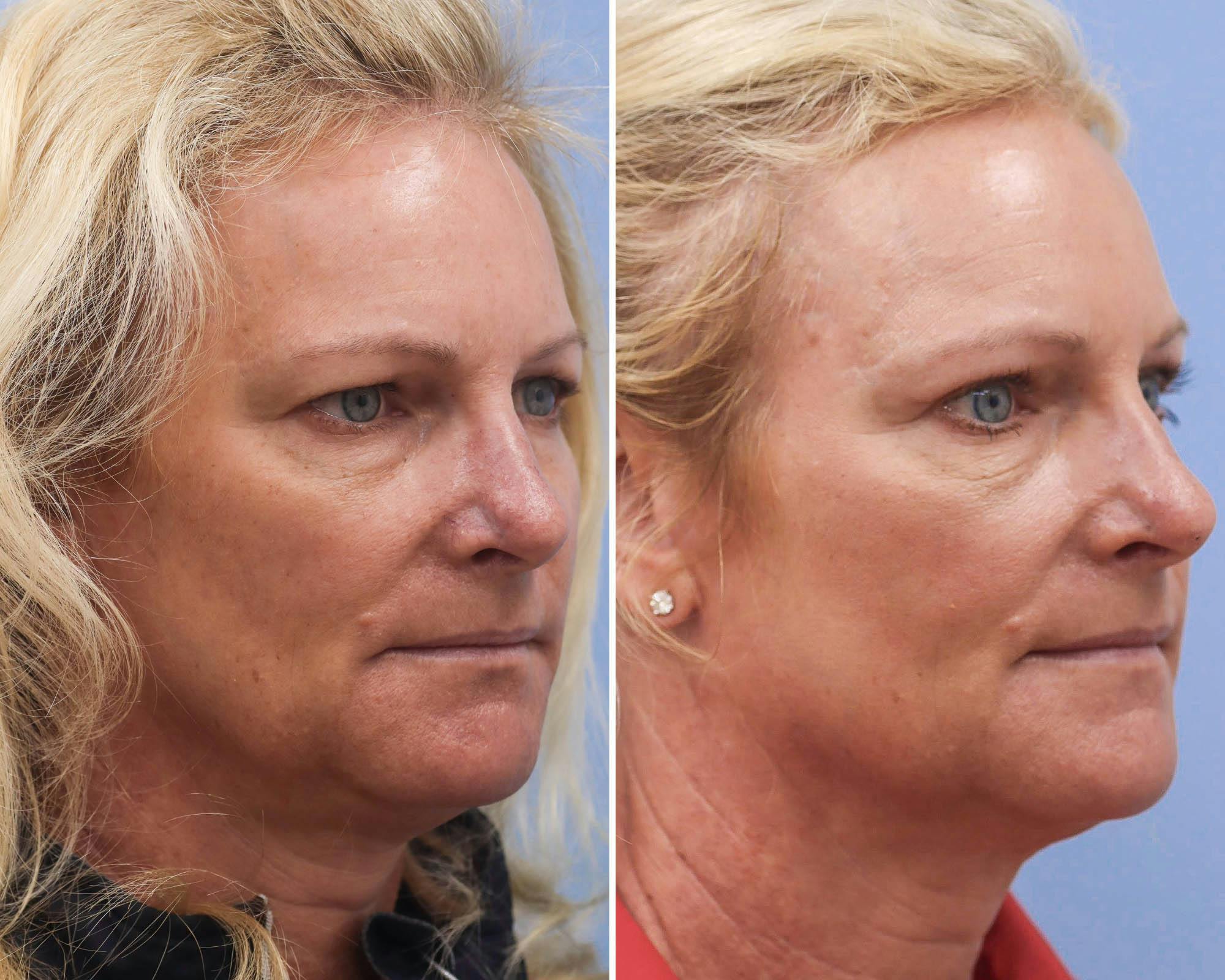 Blepharoplasty Before & After Gallery - Patient 847264 - Image 3