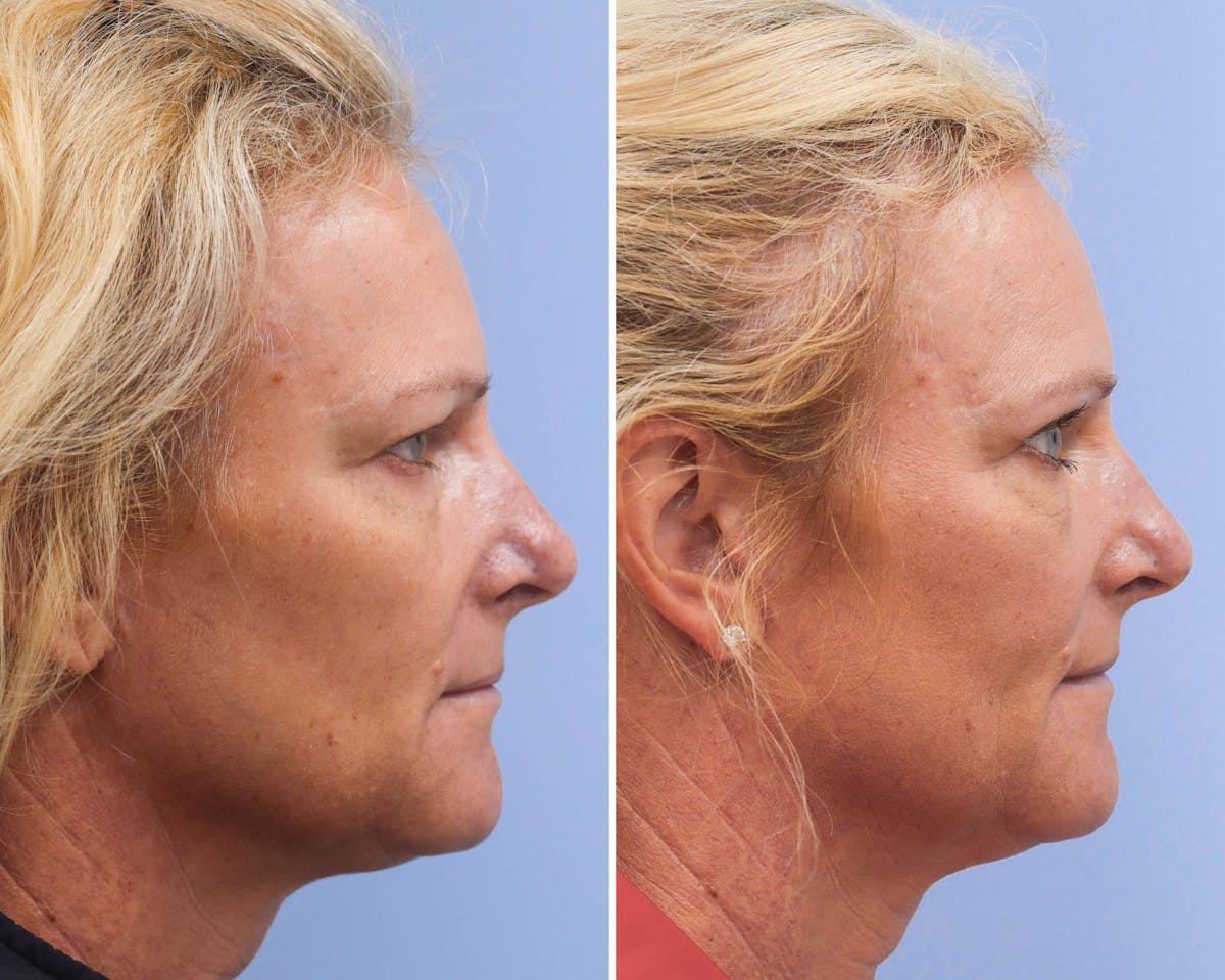 Blepharoplasty Before & After Gallery - Patient 847264 - Image 2