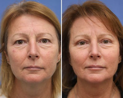 Blepharoplasty Before & After Gallery - Patient 178412 - Image 1
