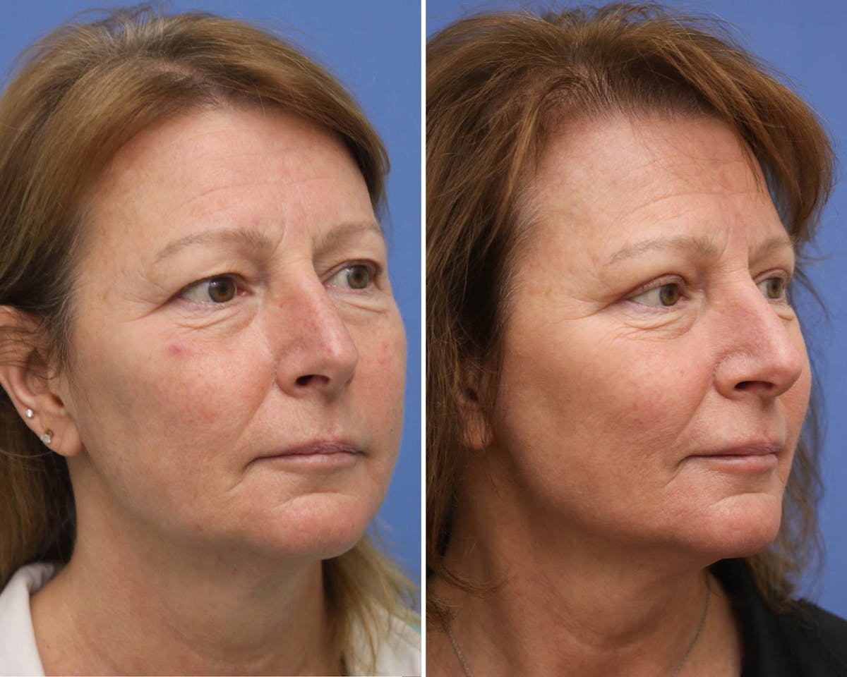Blepharoplasty Before & After Gallery - Patient 178412 - Image 3
