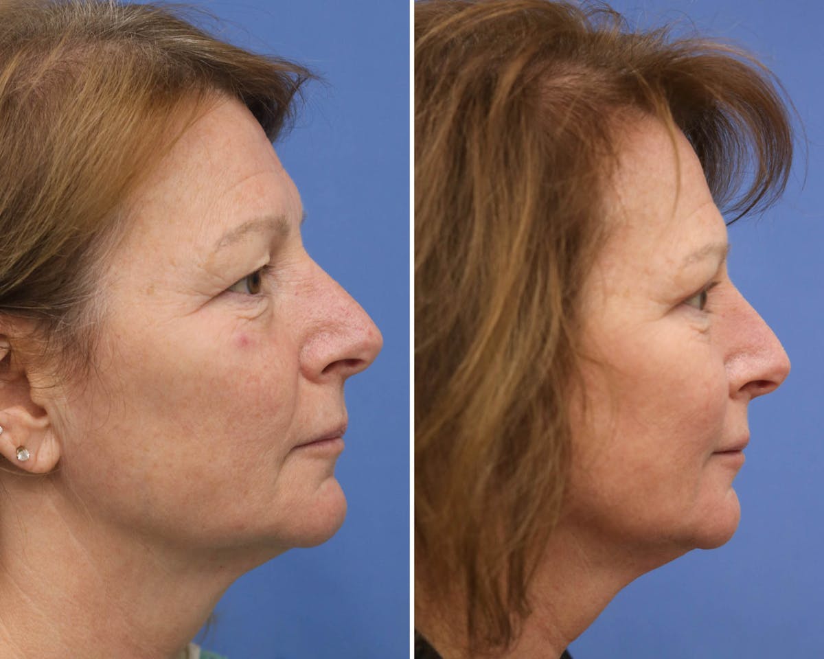 Blepharoplasty Before & After Gallery - Patient 178412 - Image 2