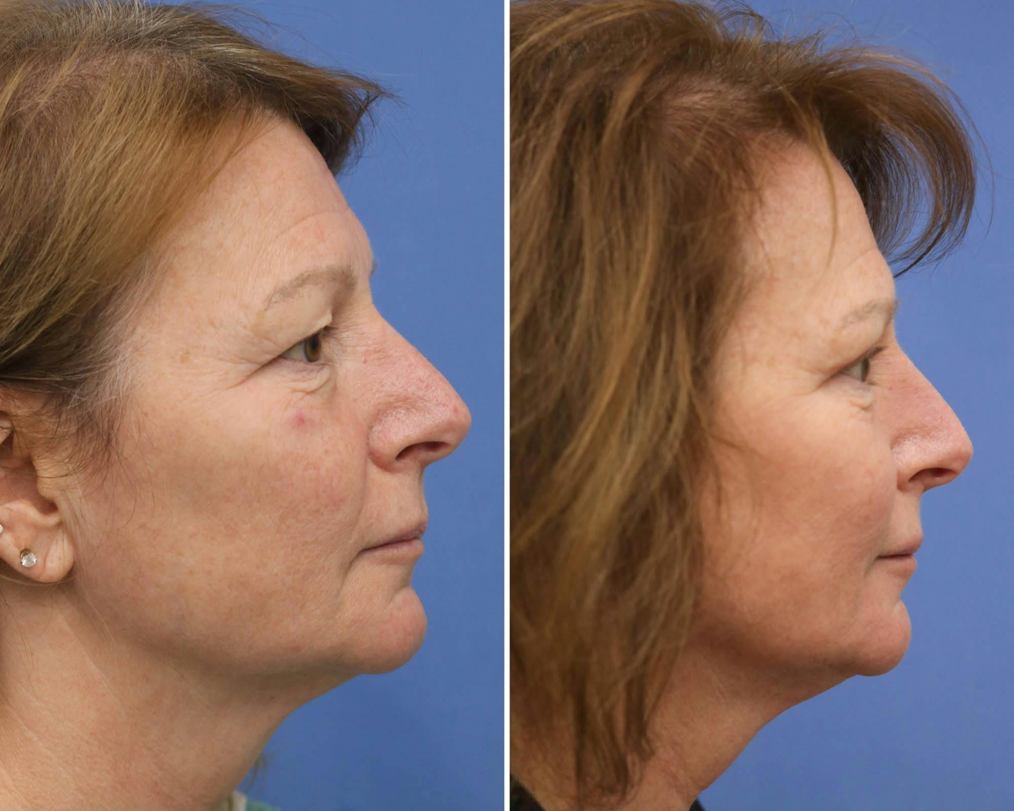 Blepharoplasty Before & After Gallery - Patient 178412 - Image 2