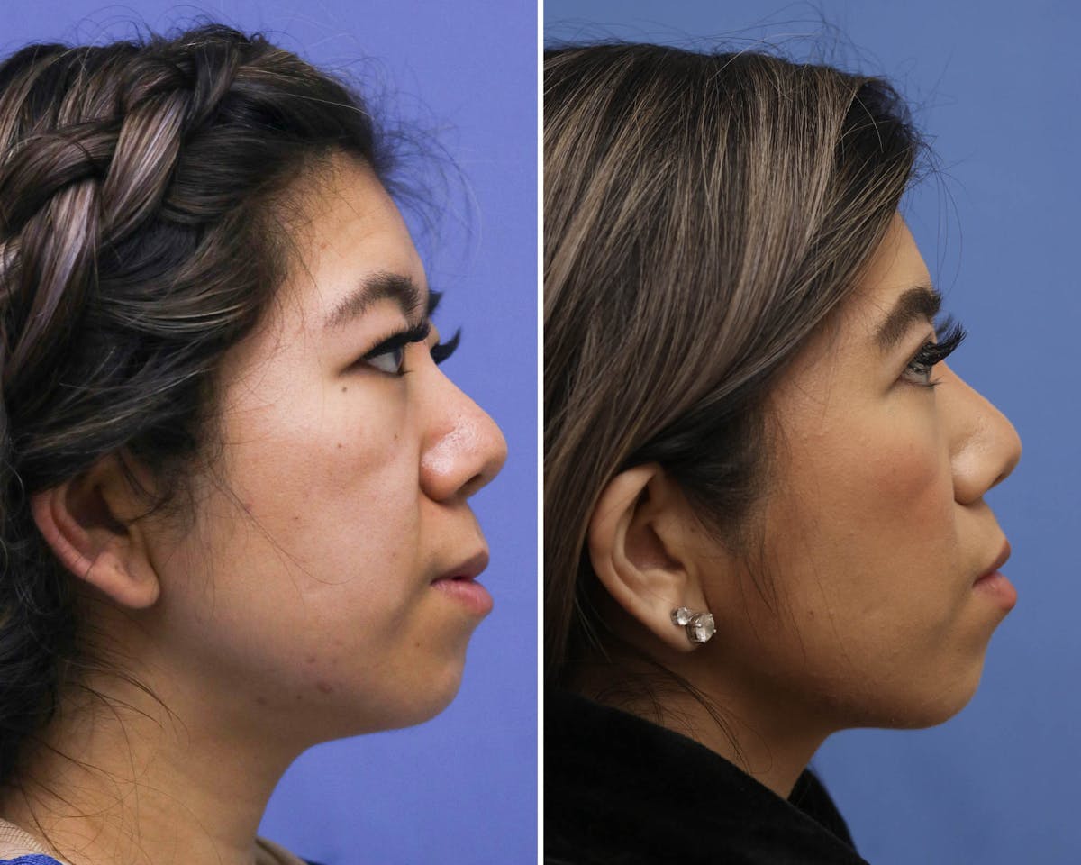 Blepharoplasty Before & After Gallery - Patient 273835 - Image 2