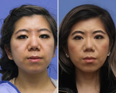 Blepharoplasty Before & After Gallery - Patient 273835 - Image 1