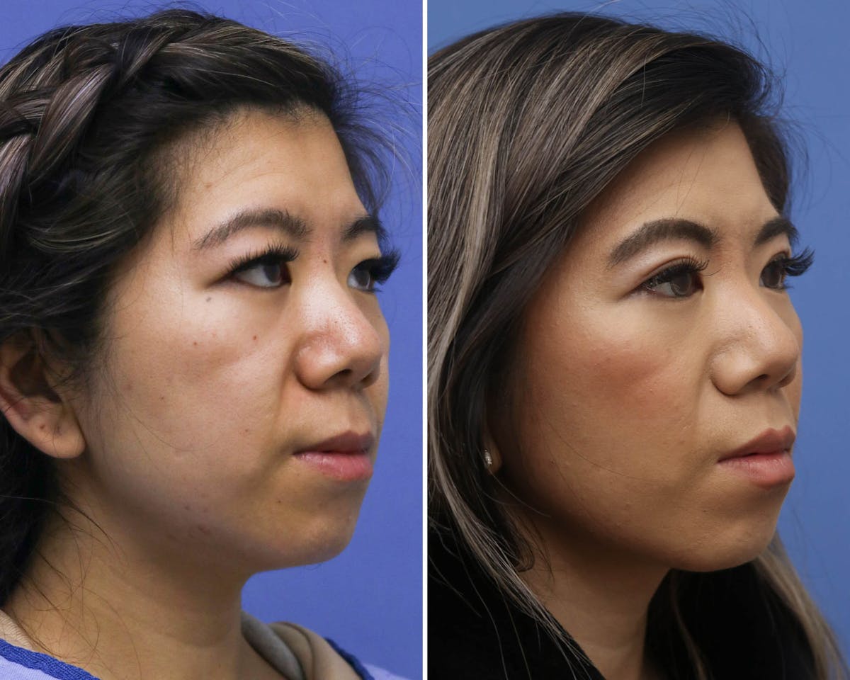 Blepharoplasty Before & After Gallery - Patient 273835 - Image 3