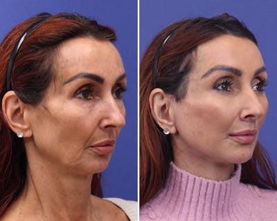 Neck Lift Before & After Gallery - Patient 893558 - Image 1
