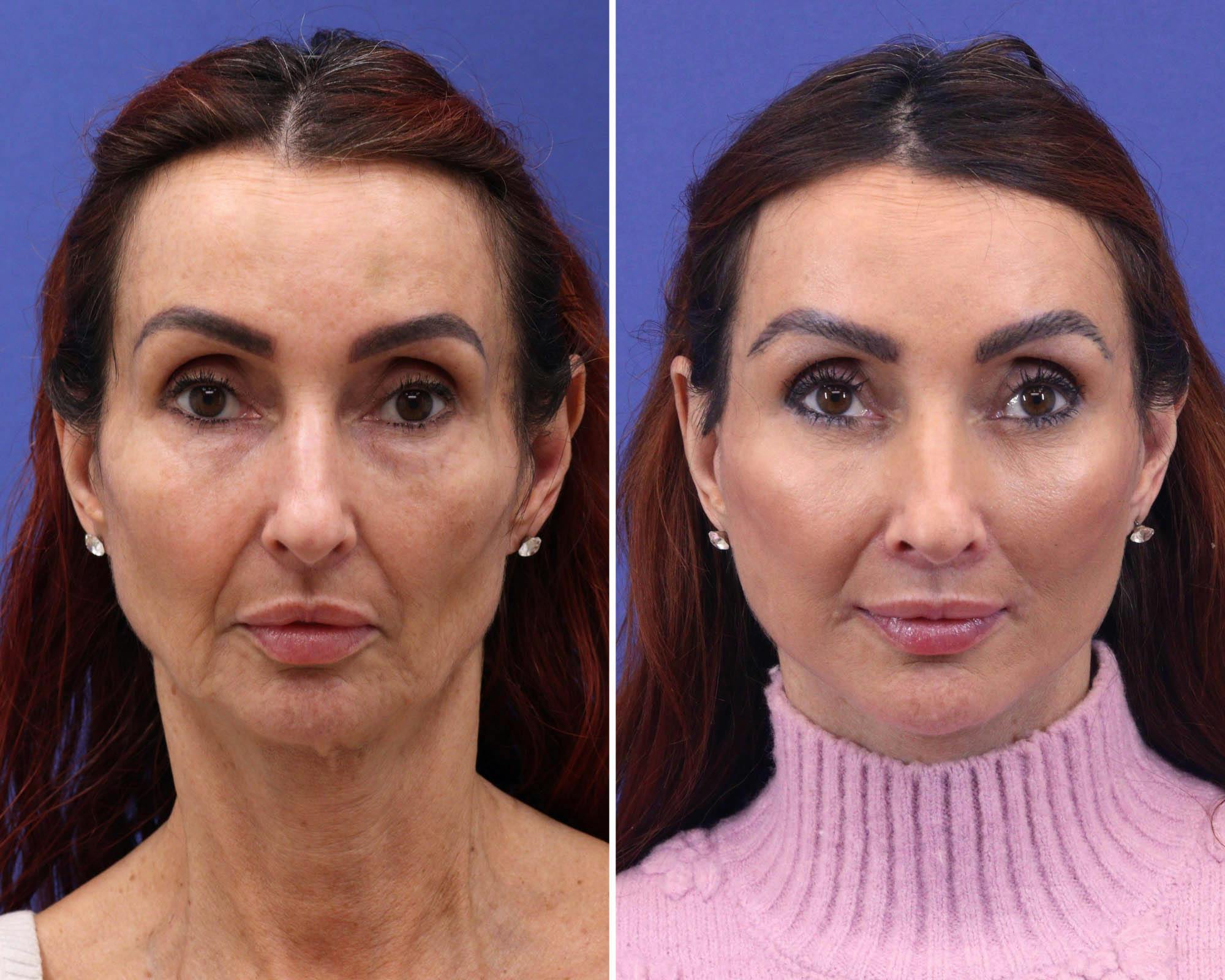 Face Before & After Gallery - Patient 555771 - Image 1