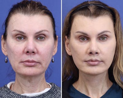 Face Before & After Gallery - Patient 144907 - Image 1