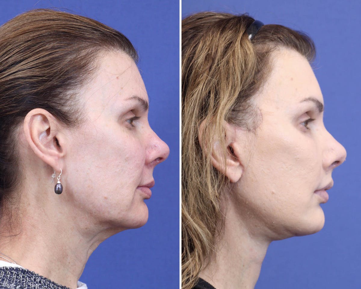 Face Before & After Gallery - Patient 144907 - Image 3