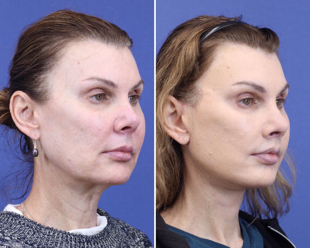 Face Before & After Gallery - Patient 144907 - Image 2