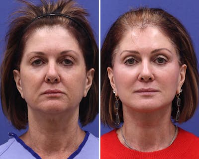 Face Before & After Gallery - Patient 140019 - Image 1