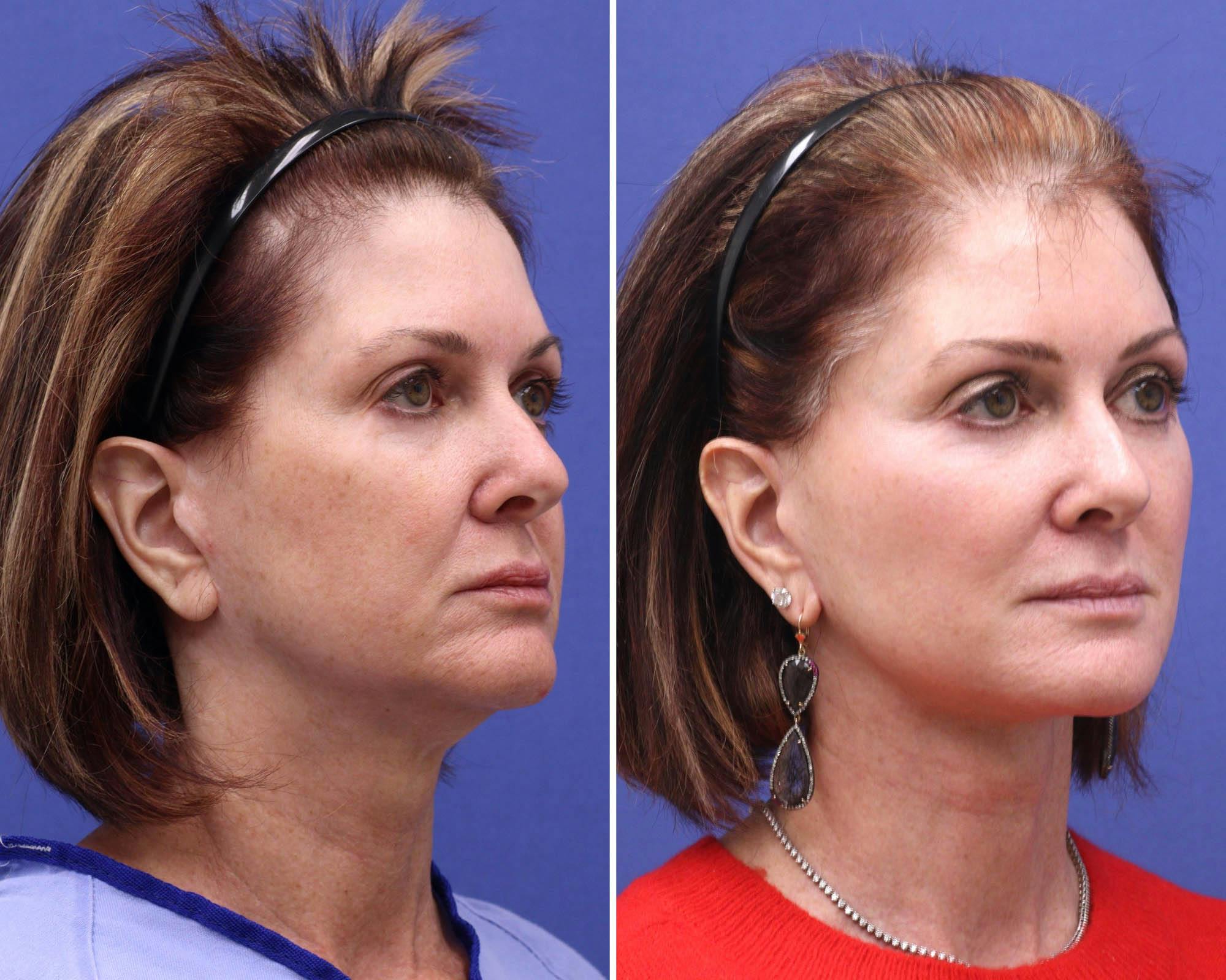Buccal Fat Removal Before & After Gallery - Patient 225752 - Image 2
